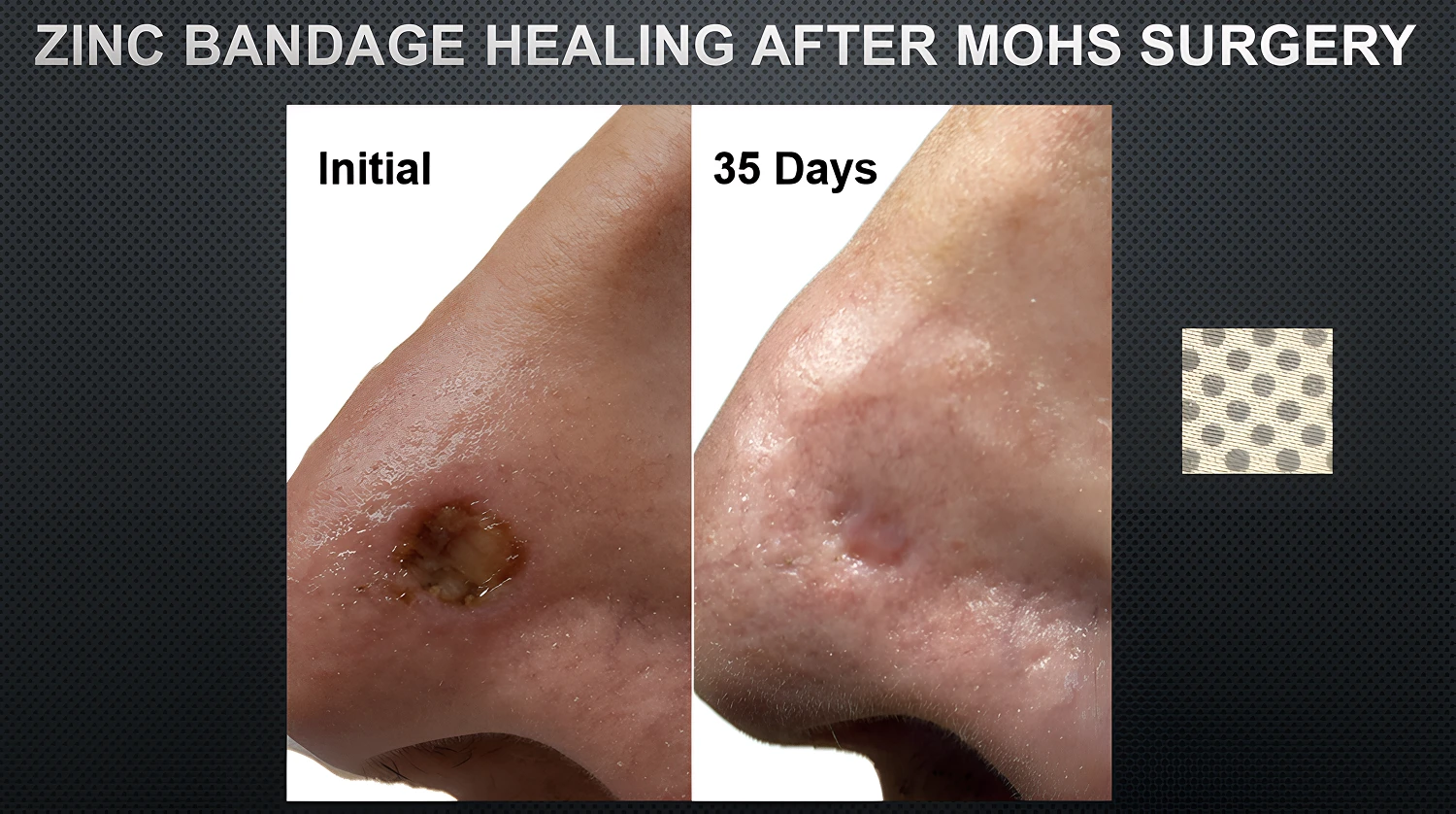 Zinc bandage skin healing before and after Mohs surgery by Ion Sportswear.