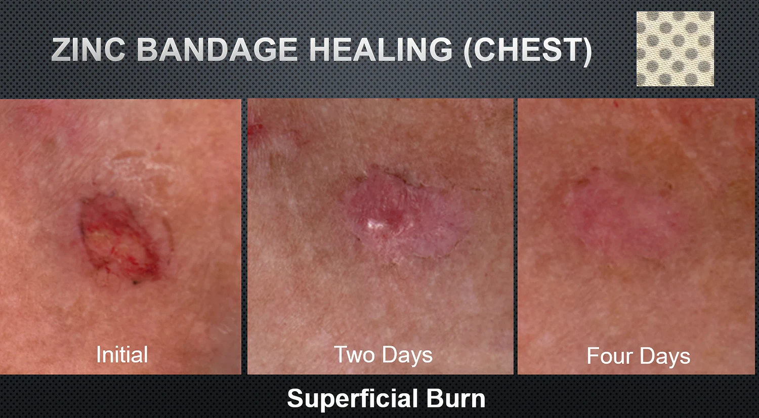 Zinc bandage burn healing timeline by Ion Sportswear.